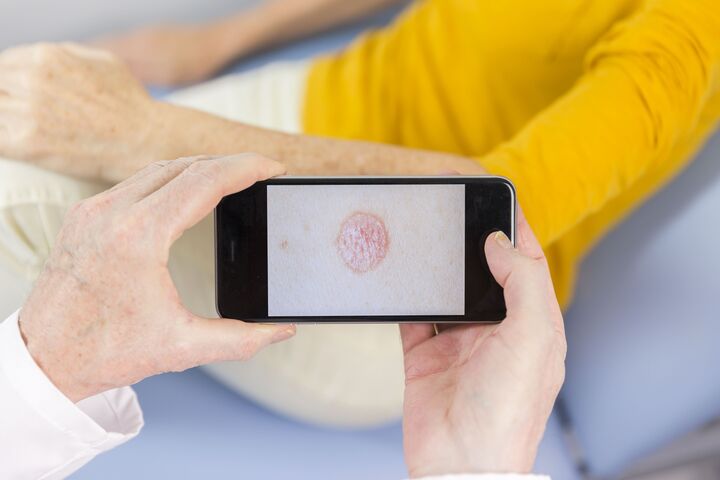 smartphone taking photo of arm with patch of psoriasis